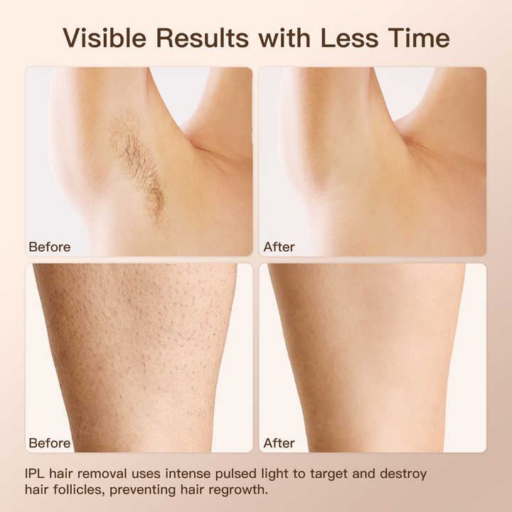 Home Laser IPL Hair Removal Device - Professional IPL Hair Removal Device Manufacturers