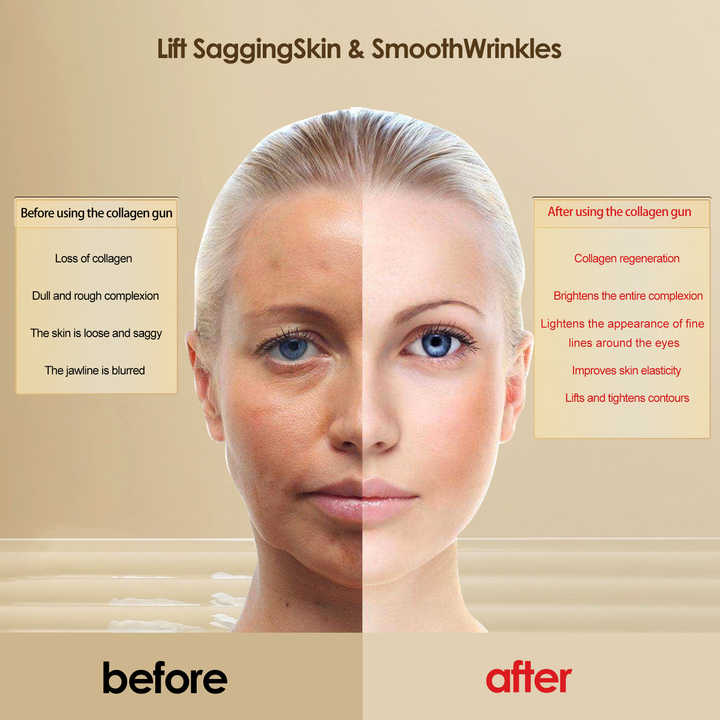 Skin tightening beauty device 