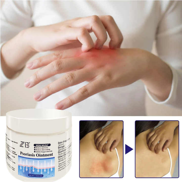 ZB Psoriasis Cream for Dermatitis and 