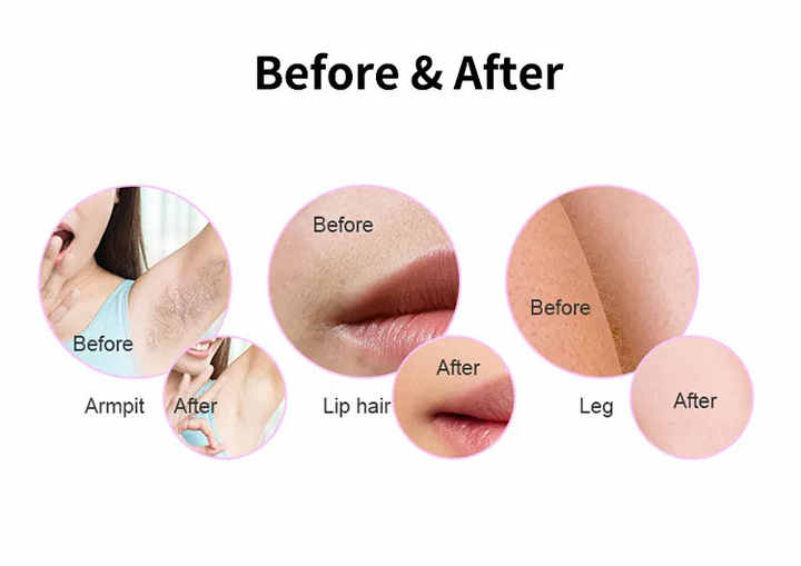 جهاز إزالة الشعر-hair removal device