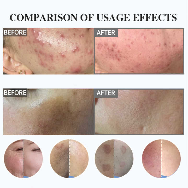 Exfoliating Spongilla - Skin Peeling Product 