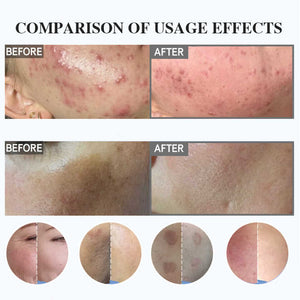 Exfoliating Spongilla - Skin Peeling Product 